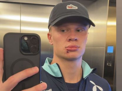 إيرلينغ هالاند بعد الإصابة التي تعرّض لها في وجهه إثر اصطدامه بباب حافلة منتخب النرويج - 7 سبتمبر 2025 - Instagram/@erling