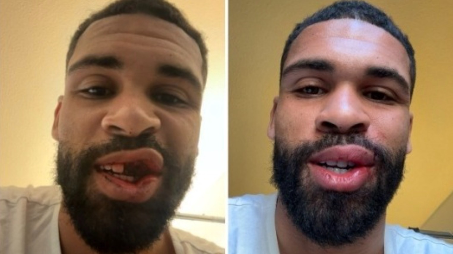 روبن لوفتوس تشيك قبل وبعد إجراء العملية الجراحية في الفك - 23 فبراير 2026